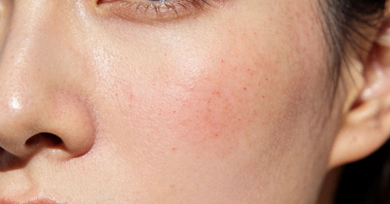 Fortalecer la barrera cutánea Strengthen Skin Barrier